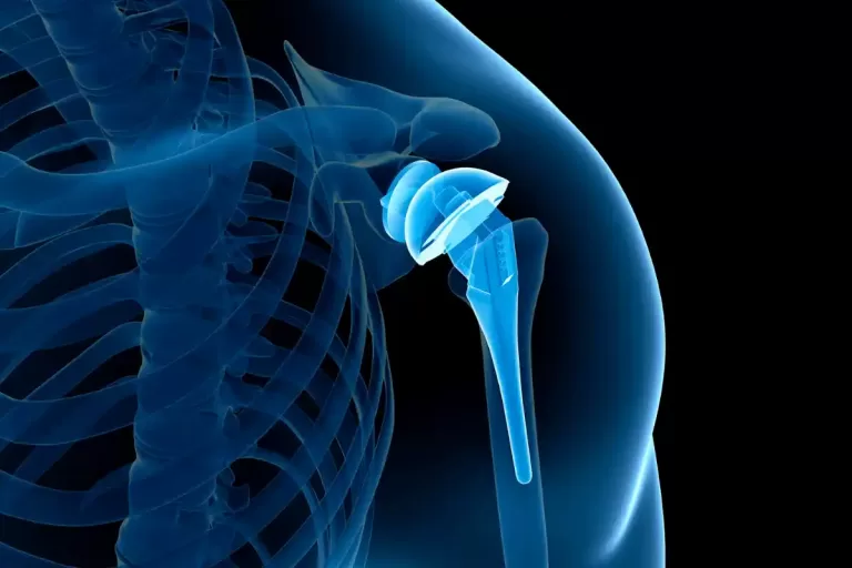 artroplastia-protese-ombro-quando-indicada