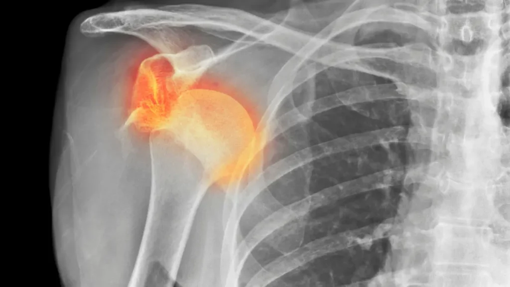 luxação acromioclavicular